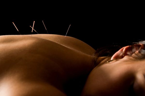 image of woman's upper back pierced with acupuncture needles