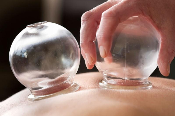 image of Chinese cupping treatment - glass cups applied to skin
